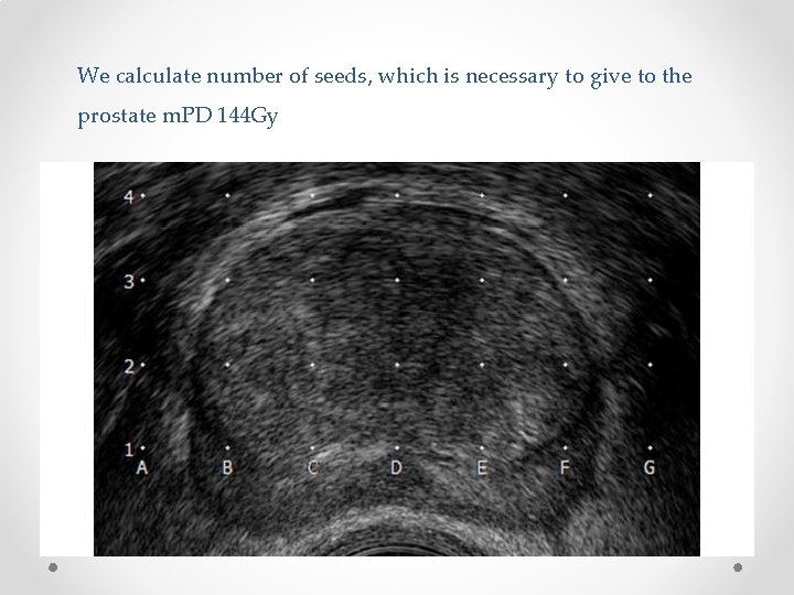We calculate number of seeds, which is necessary to give to the prostate m.
