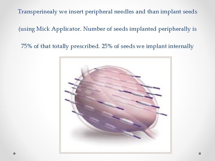 Transperinealy we insert peripheral needles and than implant seeds (using Mick Applicator. Number of