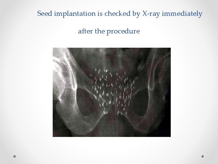 Seed implantation is checked by X-ray immediately after the procedure 