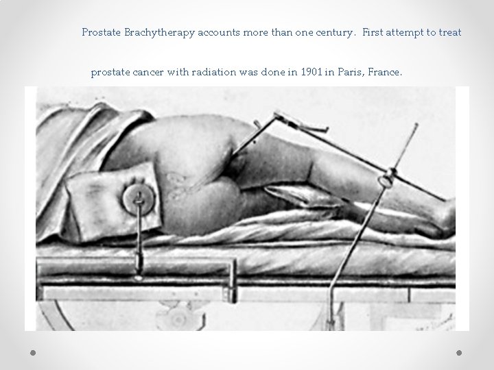 Prostate Brachytherapy accounts more than one century. First attempt to treat prostate cancer with