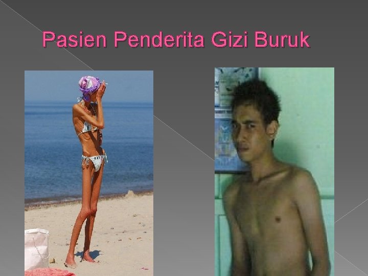 Pasien Penderita Gizi Buruk 