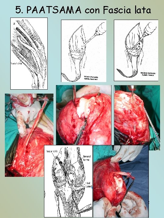 5. PAATSAMA con Fascia lata 12 