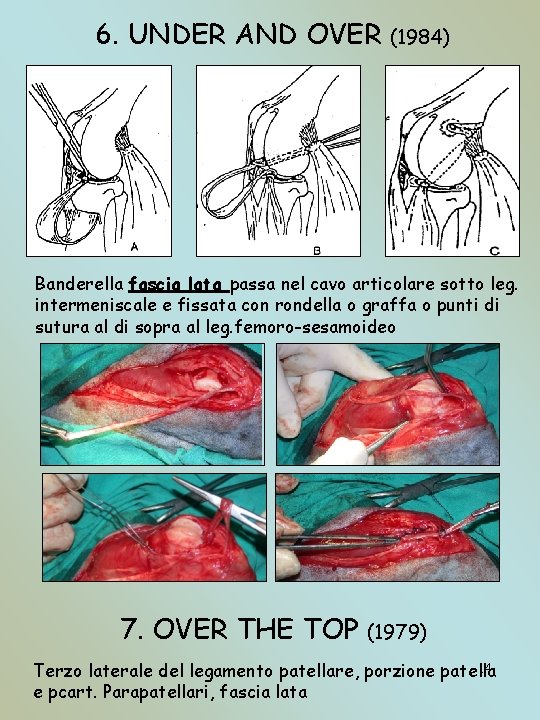 6. UNDER AND OVER (1984) Banderella fascia lata passa nel cavo articolare sotto leg.