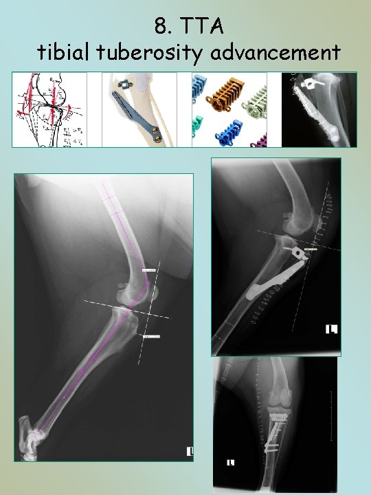 8. TTA tibial tuberosity advancement 16 