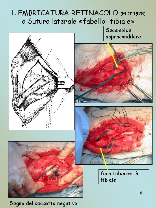 1. EMBRICATURA RETINACOLO (FLO’ 1978) o Sutura laterale «fabello- tibiale» Sesamoide sopracondilare foro tuberosità