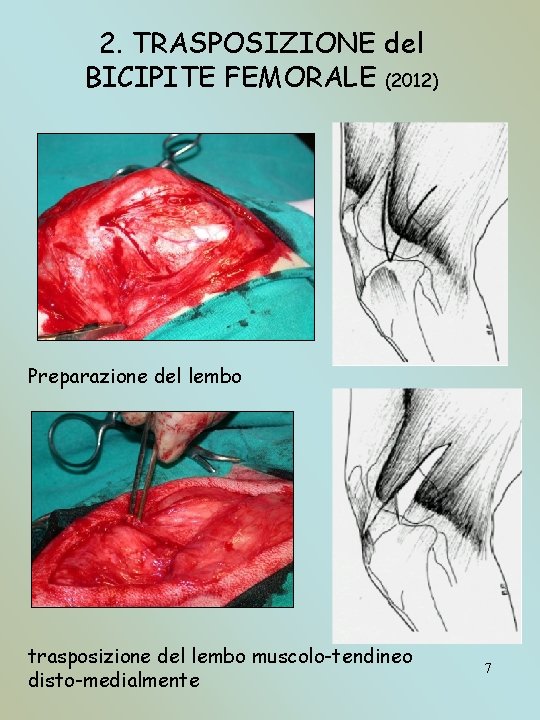 2. TRASPOSIZIONE del BICIPITE FEMORALE (2012) Preparazione del lembo trasposizione del lembo muscolo-tendineo disto-medialmente