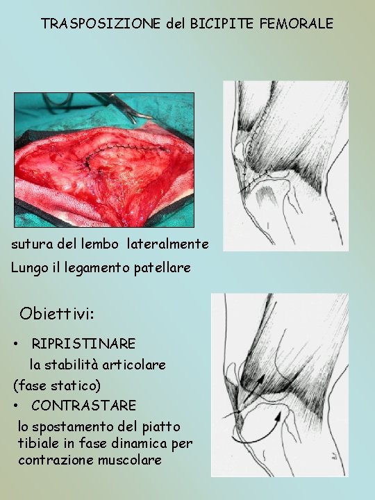 TRASPOSIZIONE del BICIPITE FEMORALE sutura del lembo lateralmente Lungo il legamento patellare Obiettivi: •