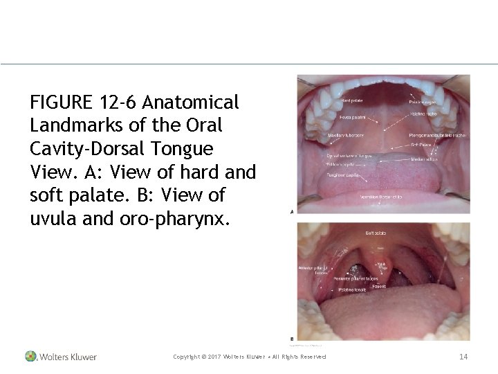 FIGURE 12 -6 Anatomical Landmarks of the Oral Cavity-Dorsal Tongue View. A: View of