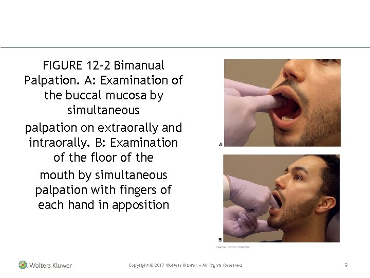 FIGURE 12 -2 Bimanual Palpation. A: Examination of the buccal mucosa by simultaneous palpation