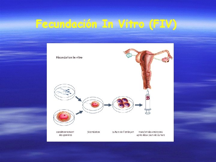 Fecundación In Vitro (FIV) 