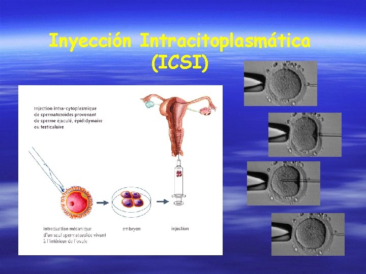 Inyección Intracitoplasmática (ICSI) 