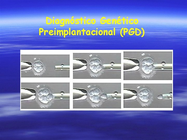 Diagnóstico Genético Preimplantacional (PGD) 