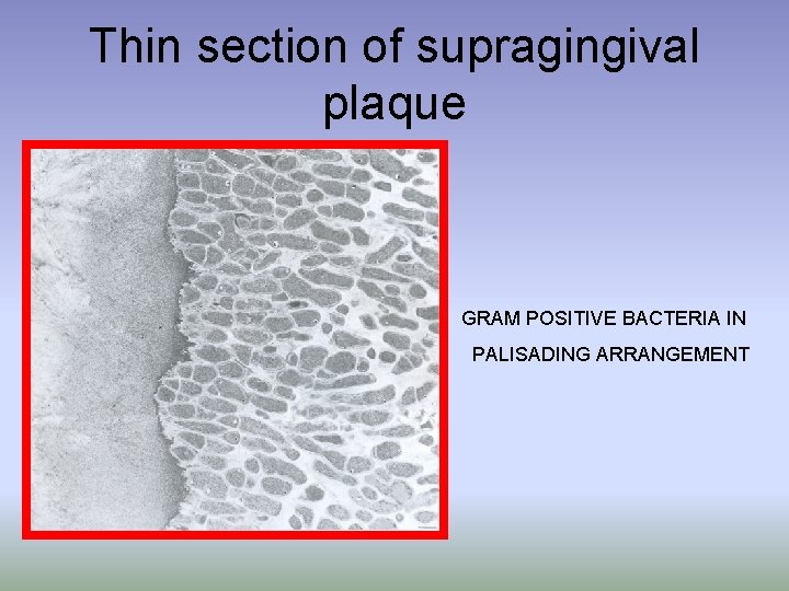 Thin section of supragingival plaque GRAM POSITIVE BACTERIA IN PALISADING ARRANGEMENT 