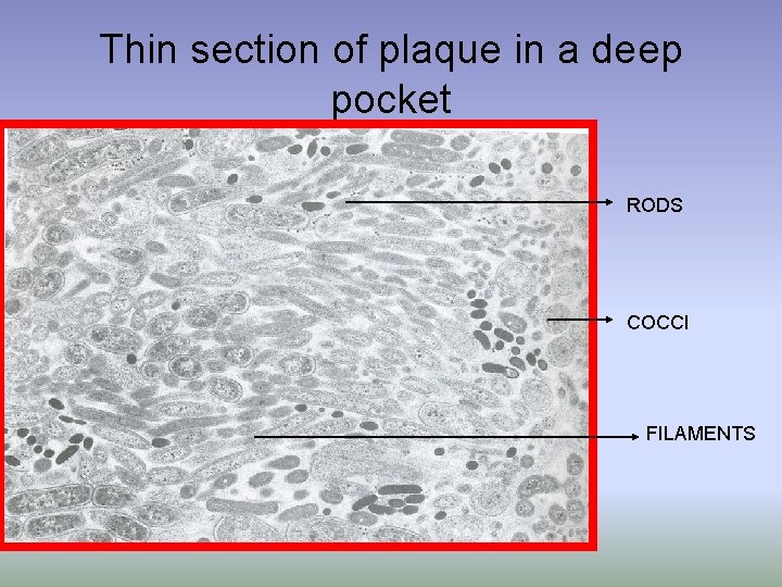 Thin section of plaque in a deep pocket RODS COCCI FILAMENTS 