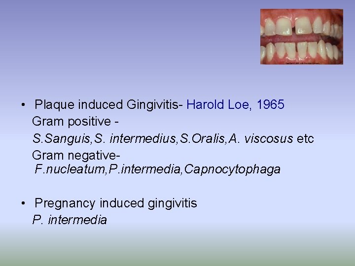  • Plaque induced Gingivitis- Harold Loe, 1965 Gram positive S. Sanguis, S. intermedius,