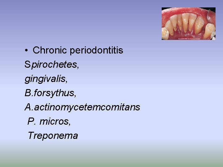  • Chronic periodontitis Spirochetes, gingivalis, B. forsythus, A. actinomycetemcomitans P. micros, Treponema 