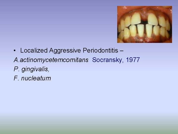  • Localized Aggressive Periodontitis – A. actinomycetemcomitans Socransky, 1977 P. gingivalis, F. nucleatum