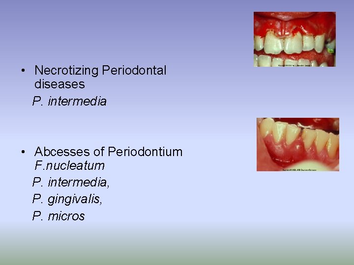  • Necrotizing Periodontal diseases P. intermedia • Abcesses of Periodontium F. nucleatum P.