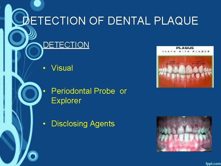 DETECTION OF DENTAL PLAQUE DETECTION • Visual • Periodontal Probe or Explorer • Disclosing