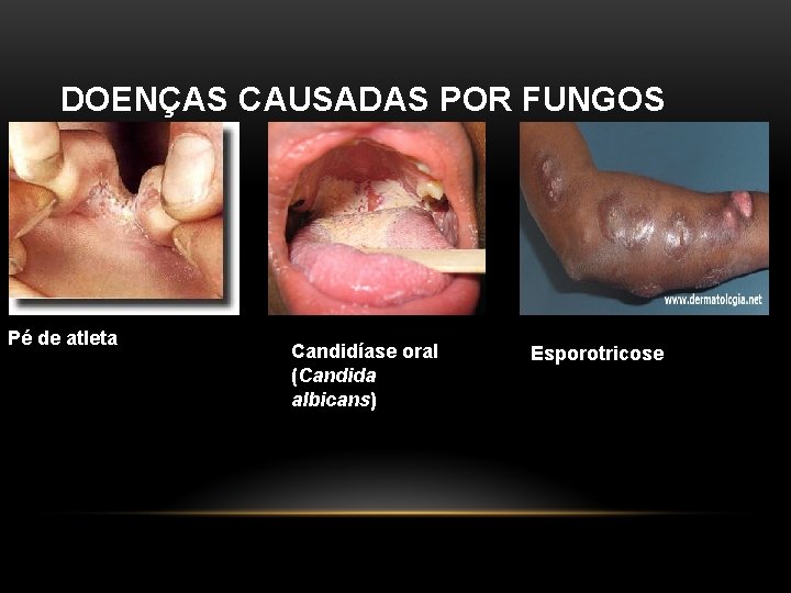 DOENÇAS CAUSADAS POR FUNGOS Pé de atleta Candidíase oral (Candida albicans) Esporotricose 