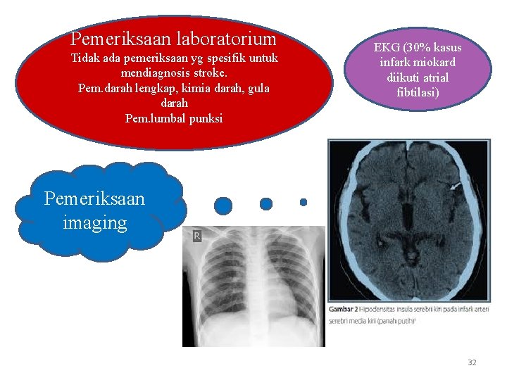 Pemeriksaan laboratorium Tidak ada pemeriksaan yg spesifik untuk mendiagnosis stroke. Pem. darah lengkap, kimia