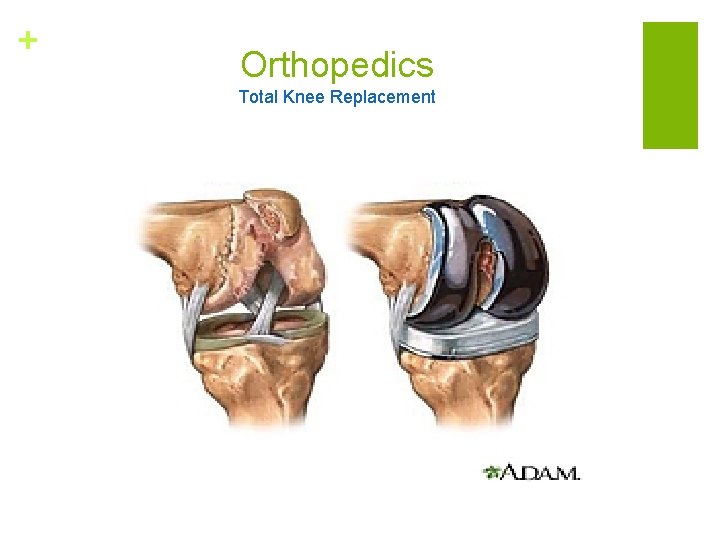 + Orthopedics Total Knee Replacement 
