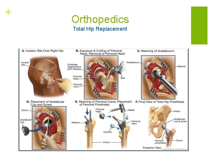 + Orthopedics Total Hip Replacement 