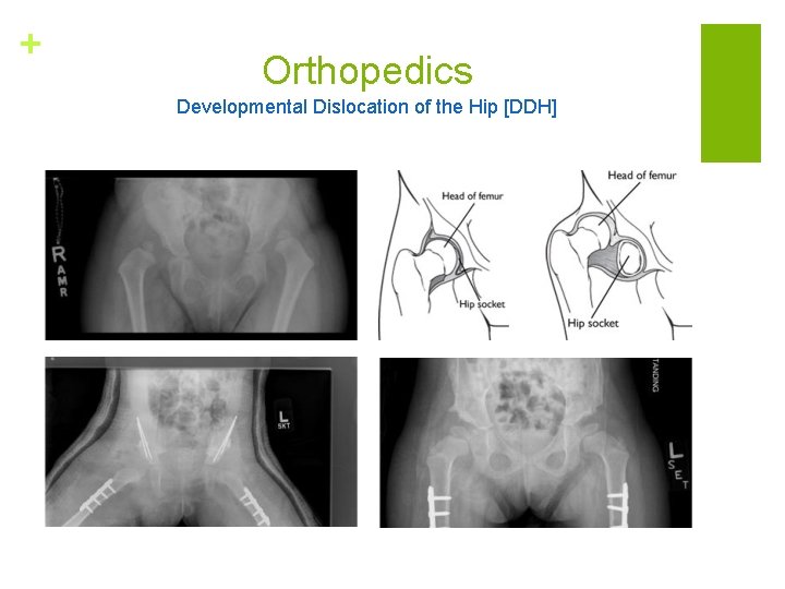 + Orthopedics Developmental Dislocation of the Hip [DDH] 