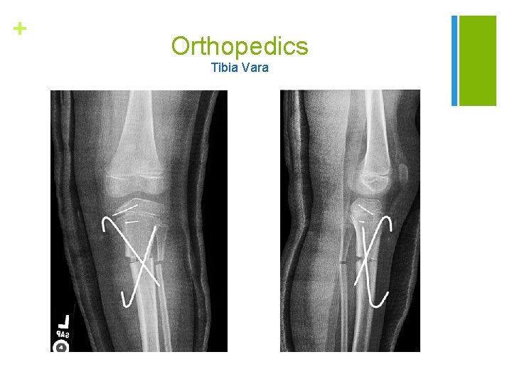 + Orthopedics Tibia Vara 