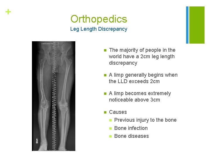 + Orthopedics Leg Length Discrepancy n The majority of people in the world have