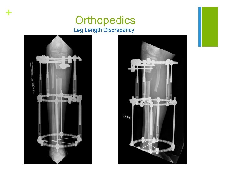 + Orthopedics Leg Length Discrepancy 