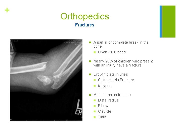 + Orthopedics Fractures n A partial or complete break in the bone n Open