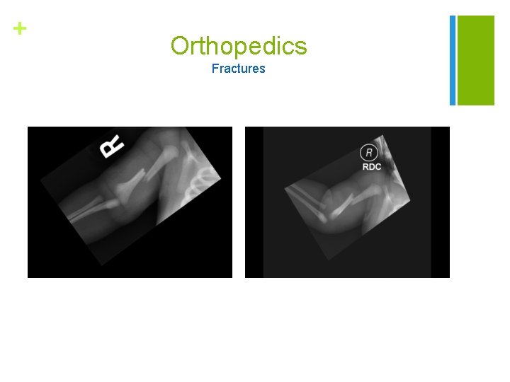 + Orthopedics Fractures 