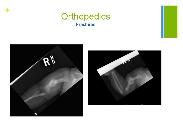 + Orthopedics Fractures 