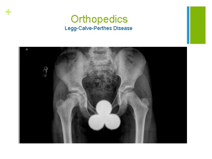 + Orthopedics Legg-Calve-Perthes Disease 