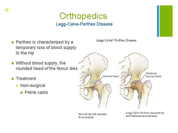 + Orthopedics Legg-Calve-Perthes Disease n Perthes is characterized by a temporary loss of blood