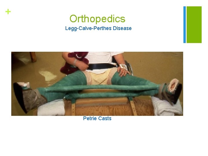 + Orthopedics Legg-Calve-Perthes Disease Petrie Casts 