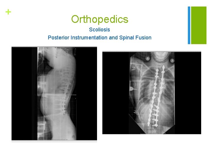 + Orthopedics Scoliosis Posterior Instrumentation and Spinal Fusion 