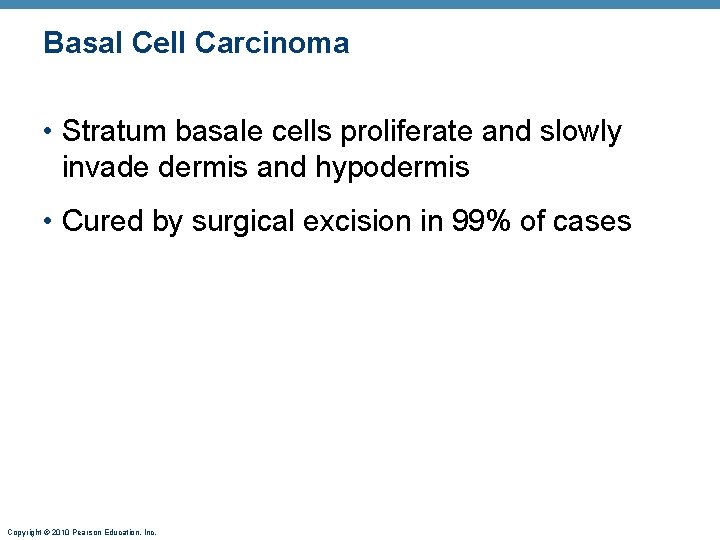 Basal Cell Carcinoma • Stratum basale cells proliferate and slowly invade dermis and hypodermis