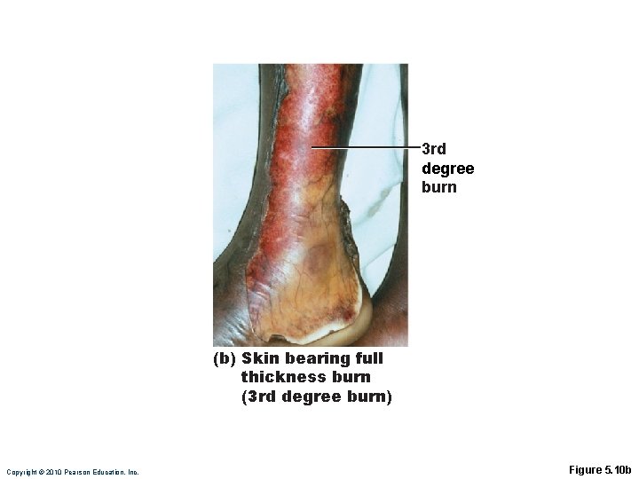 3 rd degree burn (b) Skin bearing full thickness burn (3 rd degree burn)