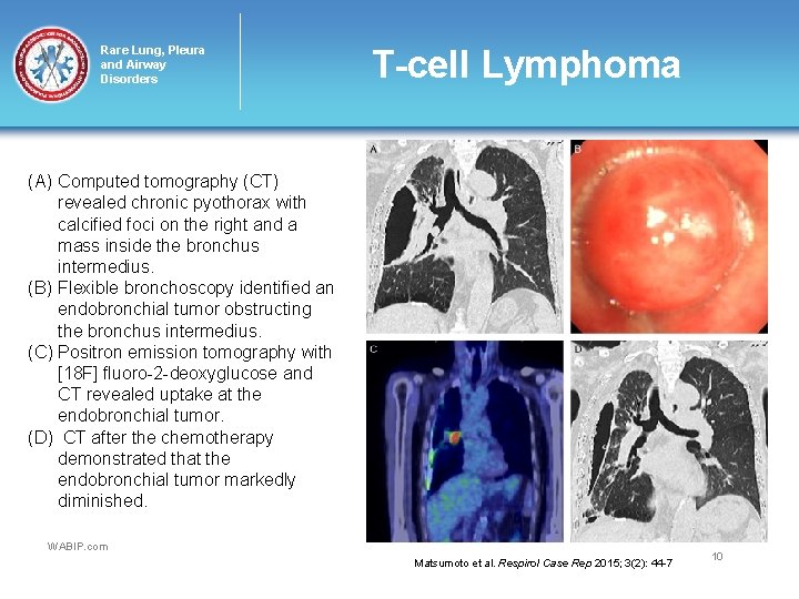 Rare Lung, Pleura and Airway Disorders T-cell Lymphoma (A) Computed tomography (CT) revealed chronic