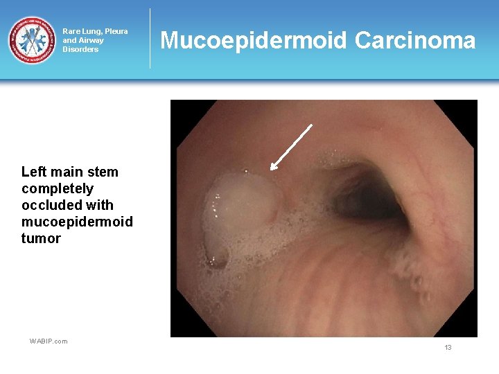 Rare Lung, Pleura and Airway Disorders Mucoepidermoid Carcinoma Left main stem completely occluded with
