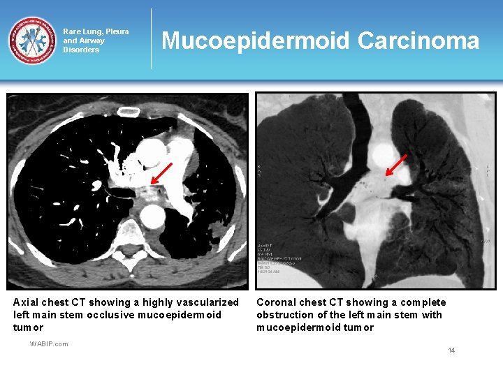 Rare Lung, Pleura and Airway Disorders Mucoepidermoid Carcinoma Axial chest CT showing a highly