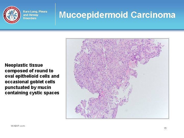 Rare Lung, Pleura and Airway Disorders Mucoepidermoid Carcinoma Neoplastic tissue composed of round to