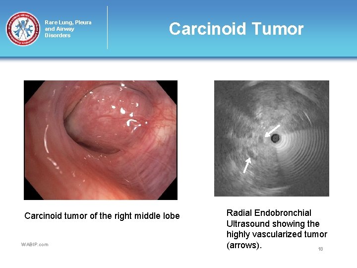 Rare Lung, Pleura and Airway Disorders Carcinoid Tumor Carcinoid tumor of the right middle