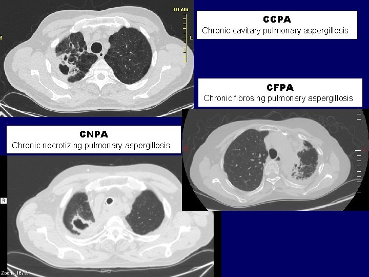 CCPA Chronic cavitary pulmonary aspergillosis CFPA Chronic fibrosing pulmonary aspergillosis CNPA Chronic necrotizing pulmonary