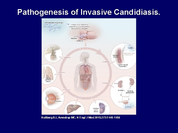 Pathogenesis of Invasive Candidiasis. Kullberg BJ, Arendrup MC. N Engl J Med 2015; 373:
