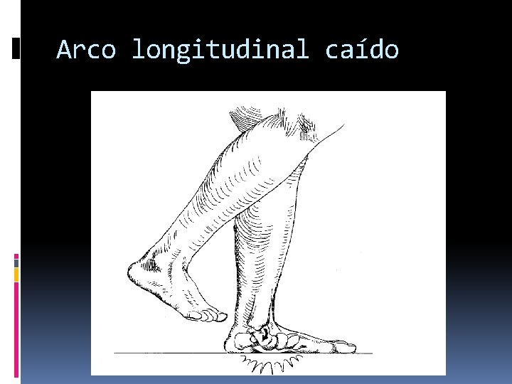 Arco longitudinal caído 