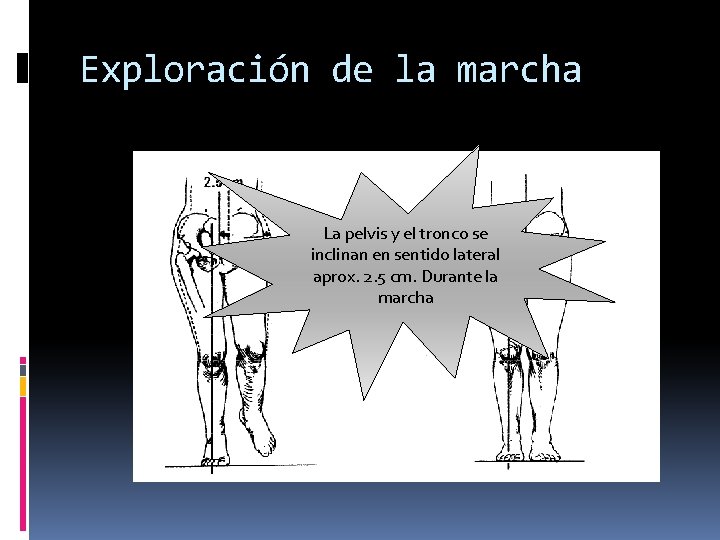 Exploración de la marcha La pelvis y el tronco se inclinan en sentido lateral