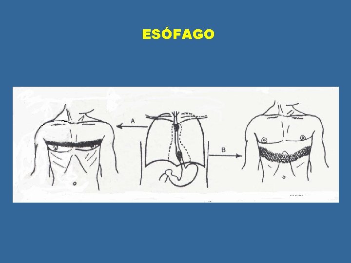 ESÓFAGO ESÓFAGO